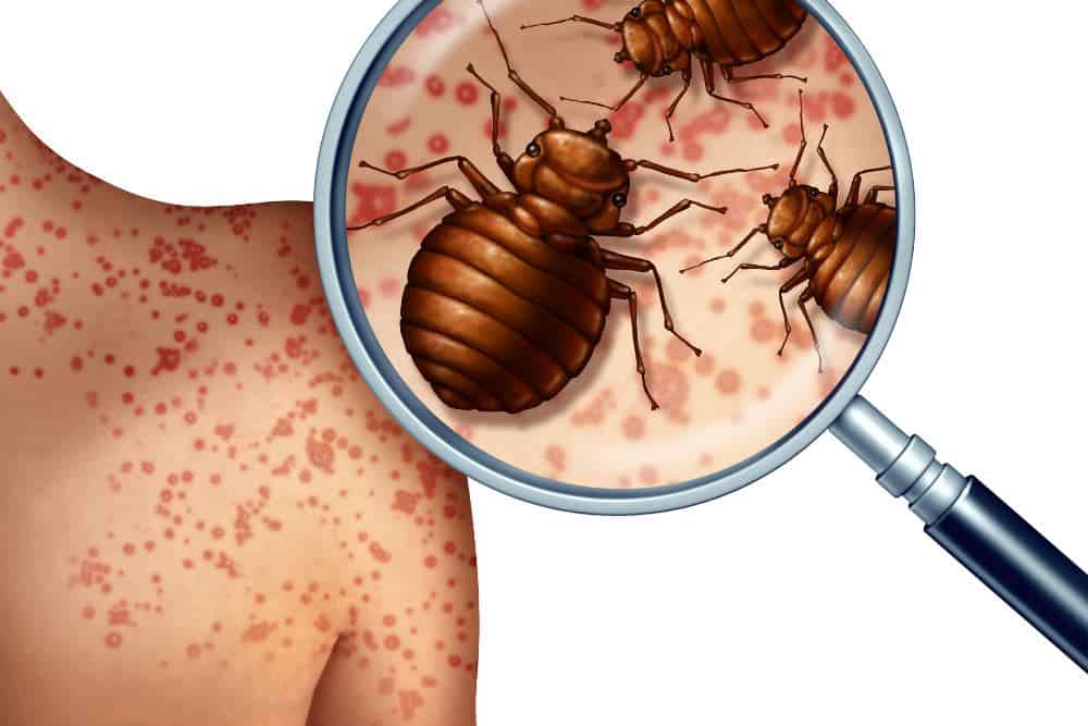 A graphical closeup of bed bugs biting a persons back shoulder area